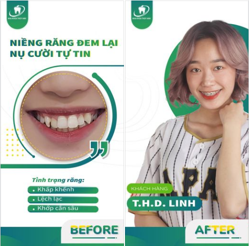 NIỀNG RĂNG TRẢ GÓP - RINH NỤ CƯỜI XINH CÙNG NHA KHOA THÙY ANH