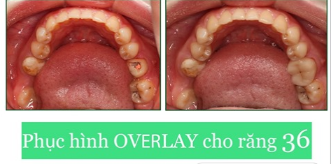  Overlay - giải pháp hoàn hảo cho những chiếc răng hàm bị sâu vỡ gần hết phần thân răng