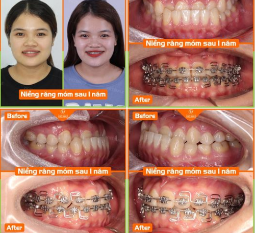  Răng móm không còn là nỗi lo 