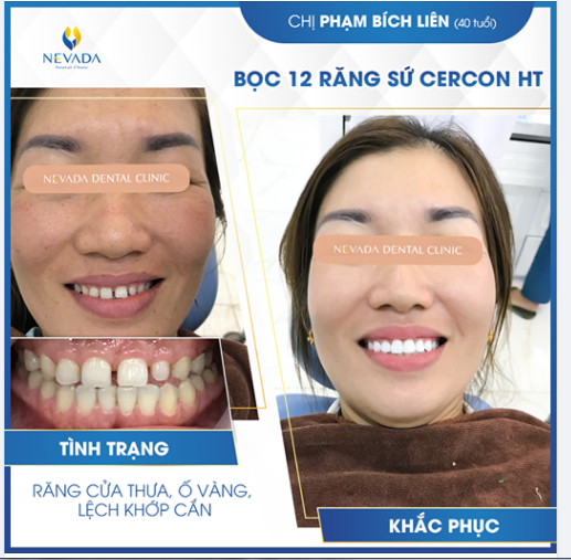 "RĂNG THƯA NÓI LÁO" - Đúng hay sai?