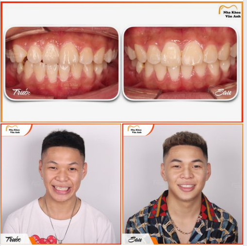 Sở hữu nụ cười đẹp chỉ sau 1 năm niềng răng của chàng trai 19 tuổi tại nha khoa Vân Anh.