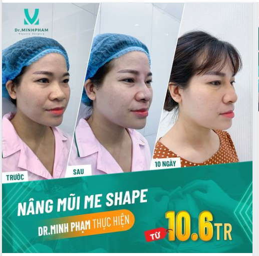 Tan chảy mọi ánh nhìn với dáng mũi Me Shape - Độc quyền Dr Minh Phạm 108