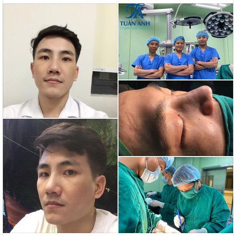 Thẩm mỹ Mũi không chỉ là Nâng mũi mà Ekip Bác sĩ Tuấn Anh còn rất thành công trong phẫu thuật tạo hình mũi, chỉnh sửa mũi lệch, vẹo hoặc xoắn. Đây là 1 trong những quy trình phẫu thuật thách thức nhất