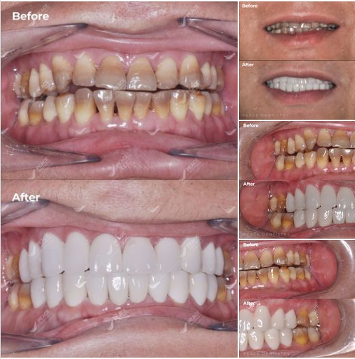  Thẩm mỹ răng sứ với phong cách nam tính cho khách hàng có răng bị nhiễm Tetracycline