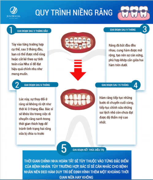 Thông thường, quy trình niềng răng có thể kéo dài từ 1 đến 2 năm
