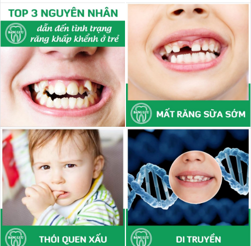 TOP 3 nguyên nhân dẫn đến tình trạng răng khấp khểnh ở trẻ