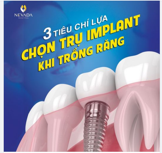 3 TIÊU CHÍ LỰA CHỌN TRỤ IMPLANT KHI TRỒNG RĂNG