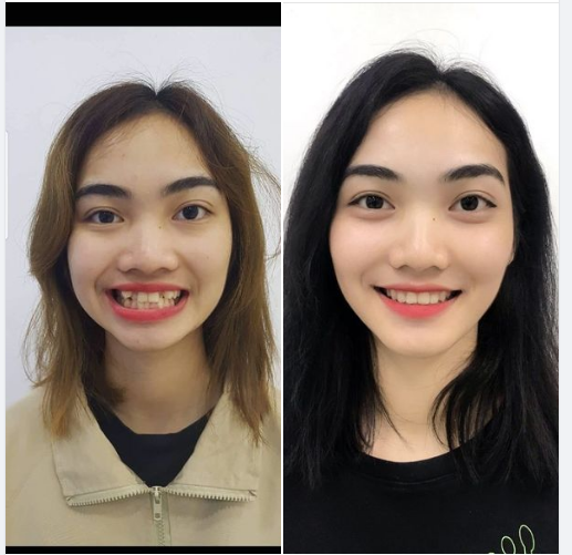 Bạn Thu Hương đã thực sự thay đổi sau 1 năm 8 tháng niềng răng