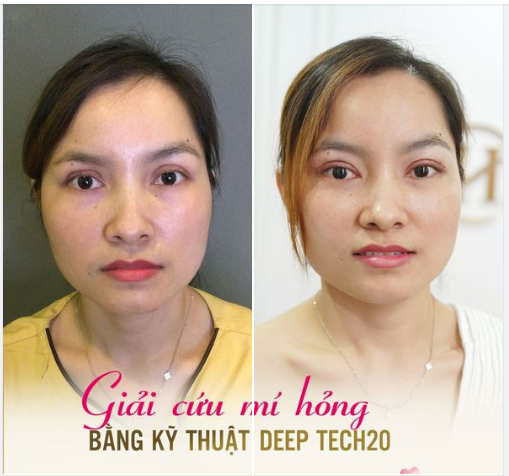 "BÍ MẬT" ĐÃ ĐƯỢC "BẬT MÍ" Sửa mí Deep Tech20 tại Dr.Hải Lê - Giải pháp tuyệt vời khắc phục các khuyết điểm “xấu, hỏng” của đôi mắt: