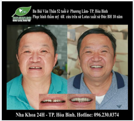 BN Bùi Văn Thân 52 tuổi ở Phương Lâm-TP. Hòa Bình. Đến với Nha Khoa 24H trong tình trạng các răng cửa trên hỏng tủy, thưa, hô, hình thể không đẹp.
