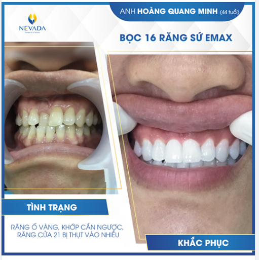 BỌC RĂNG SỨ CHO RĂNG XỈN MÀU, KHẤP KHỂNH SẼ "LỘT XÁC" RA SAO?
