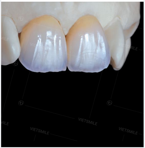 Cận cảnh miếng dán sứ Veneer đắp thủ công 7 - 9 lớp sứ với hiệu ứng ấm vùng cổ răng vàng ánh vàng nhẹ đặc trưng của răng tự nhiên và chuyển dần sang màu trắng và trắng trong vùng cạnh cắn