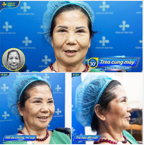 Cô Diệu Minh (71 tuổi, Hải Phòng) đã tìm đến bác sĩ để khắc phục tình trạng da chùng nhiều gây sụp mí + đuôi mắt cụp bằng phương pháp treo cung mày.