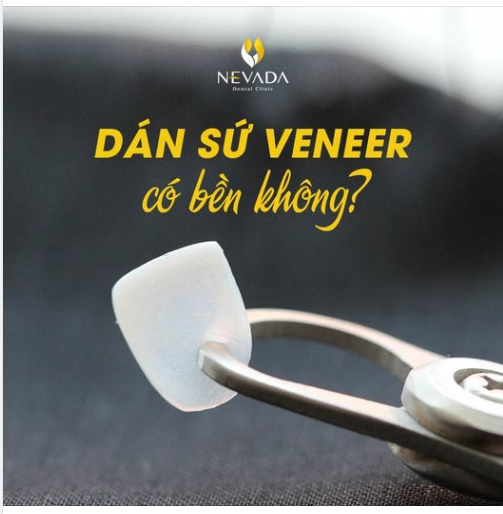 DÁN SỨ VENEER CÓ BỀN KHÔNG?
