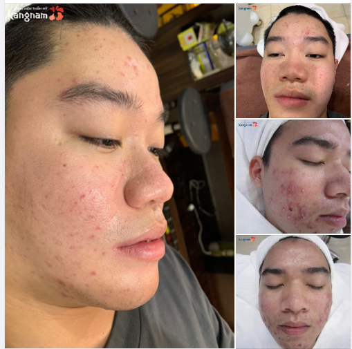 Điều trị mụn lâu năm triệt để CHỈ sau 1 liệu trình chuyên sâu Nano Skin tại Kangnam