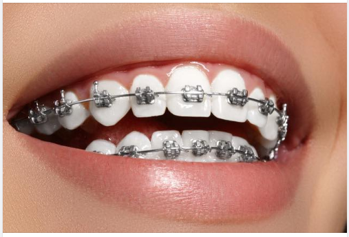 Độ tuổi niềng răng tốt nhất từ 12 - 16 tuổi vậy người lớn từ 17 - 35 tuổi có niềng răng được không