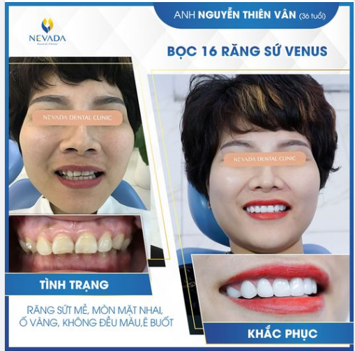 HẾT SỨT MẺ - Ố VÀNG- MÒN MẶT NHAI