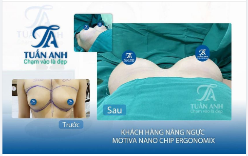 Hình ảnh sau phẫu thuật NÂNG NGỰC túi Motiva Nano Chip Ergonomix của khách hàng xinh đẹp nhé các chị em!