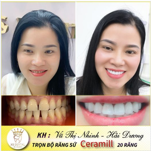 Hoàn thành xong ca thẩm mỹ 20 răng sứ Ceramill Tại nha khoa xs Dental 136 Tây Sơn - Đống Đa - Hà Nội .