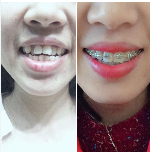 Kết quả sau 1 năm niềng răng , chị Minh Anh đã tự tin cười và giao tiếp với bạn bè