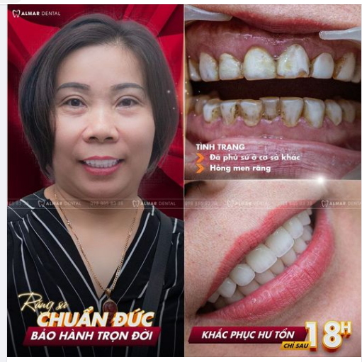 Khách hàng: chị Hiền Trần- kinh doanh tự do , đã Xinh Đẹp và Tự Tin hơn sau quá trình thẩm mỹ 19 răng sứ cao cấp tại nha khoa Almar Dental