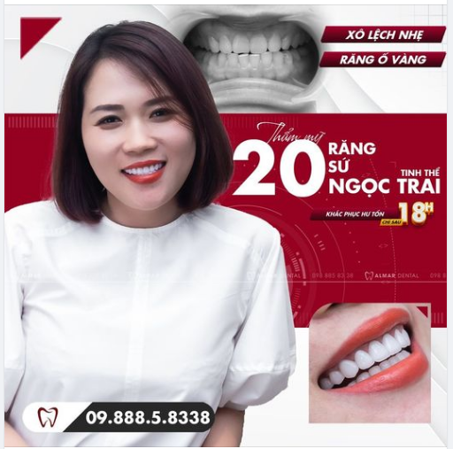 Khách hàng: chị Hồng Hà- nhân viên Ngân hàng, càng xinh đẹp hơn sau quá trình thẩm mỹ 20 răng sứ TINH THỂ NGỌC TRAI cao cấp tại nha khoa Almar Dental