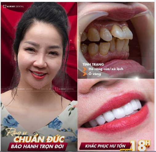 Khách hàng: chị Phương- càng xinh đẹp hơn sau quá trình thẩm mỹ 16 răng sứ cao cấp tại nha khoa Almar Dental khắc phục mọi khuyết điểm của hàm răng cũ ố vàng, hô, hình thể răng không đều, xô lệch.