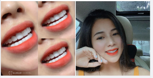 Khách hàng: chị Vân Anh càng xinh đẹp hơn sau quá trình thẩm mỹ 16 răng toàn sứ cao cấp HT Smile tại nha khoa Almar Dental