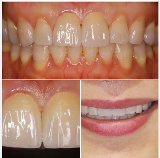 Lại thêm một trường hợp răng sứ mà như răng thật, răng nào là răng thật, răng nào là răng sứ?​​​​​​​