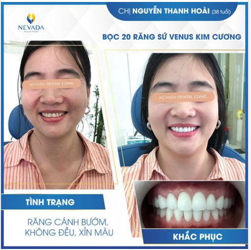 LÝ DO ĐỂ BẠN QUYẾT TÂM LÀM RĂNG LÀ ĐÂY