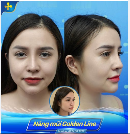 Mũi đã tiêm filler nhưng không đạt được kỳ vọng như mong muốn, bạn gái quyết định nâng mũi Golden Line - Dr.Tống Hải.