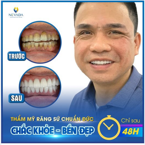 MUỐN RĂNG "BỀN - ĐẸP" HÃY CHỌN NEVADA!