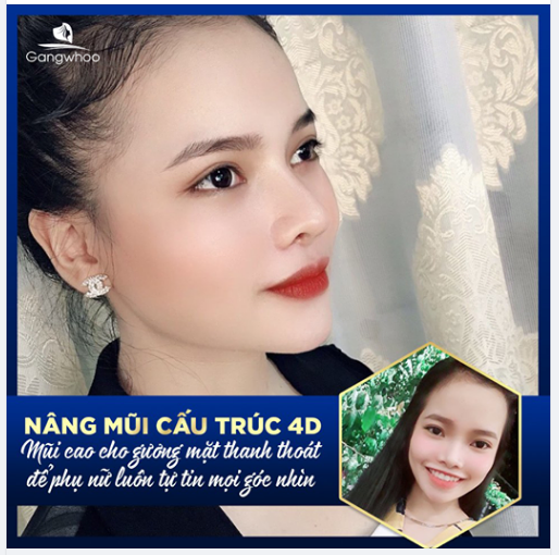 NÂNG MŨI CẤU TRÚC 4D - MŨI CAO CHO GƯƠNG MẶT THANH THOÁT