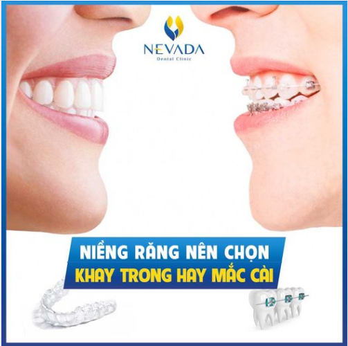 NÊN CHỌN NIỀNG RĂNG KHAY TRONG HAY MẮC CÀI?