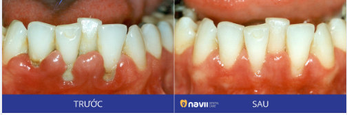 Nếu không được điều trị kịp thời VIÊM NHA CHU có thể dẫn đến MẤT RĂNG HOÀN TOÀN