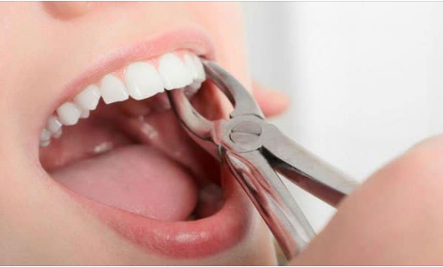 Nhổ răng khi niềng có ảnh hưởng sức khỏe không