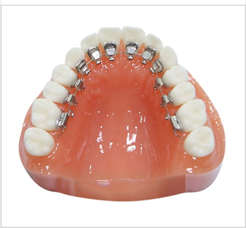 Niềng răng mặt trong là phương pháp chỉnh nha hiện đại, phương pháp này sử  dụng