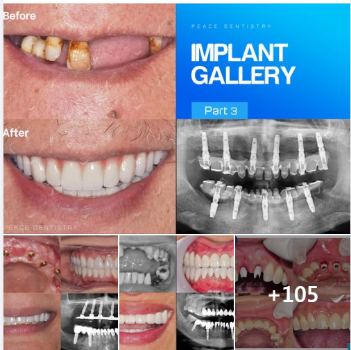 PEACE DENTISTRY GALLERY - IMPLANT (PART 3)