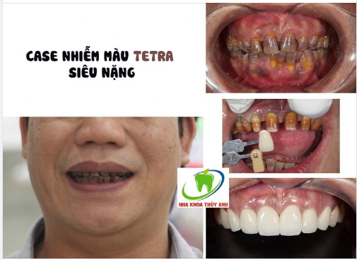 Phục hình răng thẩm mỹ cho trường hợp răng nhiễm màu tetracycline siêu nặng tại Nha Khoa Thùy Anh Hà Nội!