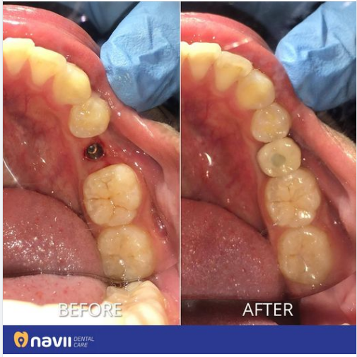 Răng 35 của bệnh nhân bị nứt dọc & chết tủy hoàn toàn