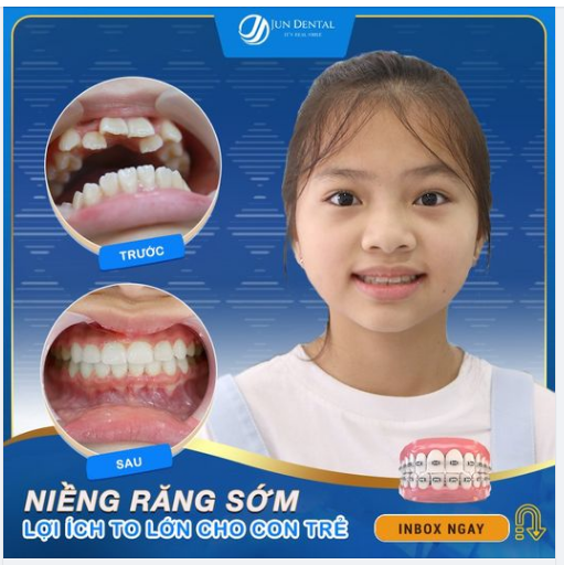 Răng của bé Khánh Mỹ hiện nay đã đẹp mỹ mãn sau gần 2 năm gắn bó với chiếc niềng.