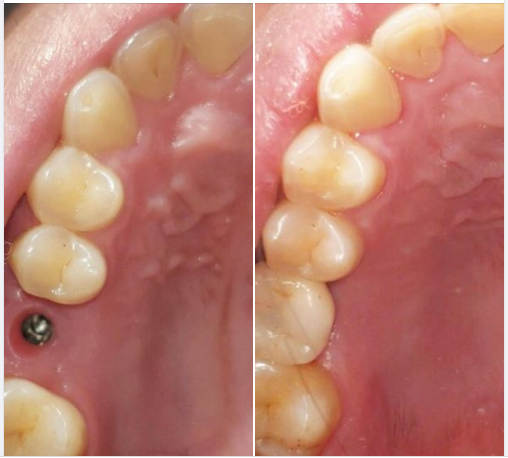 Răng IMPLANT - giải pháp thay thế răng mất tốt nhất