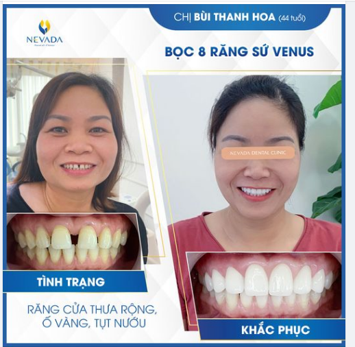 RĂNG THƯA - HỎNG VẬN Ư? Đã có THẨM MỸ RĂNG SỨ INVY ULTRA 5P của Nevada lo!!