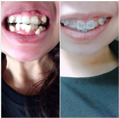 Sau 8 tháng niềng răng , tình trạng răng lộn xộn của chị Linh Nga đã dần được cải thiện