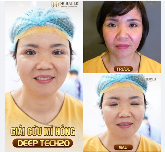 Tại sao sửa mí Deep Tech20 tại Dr.Hải Lê được hàng ngàn người lựa chọn