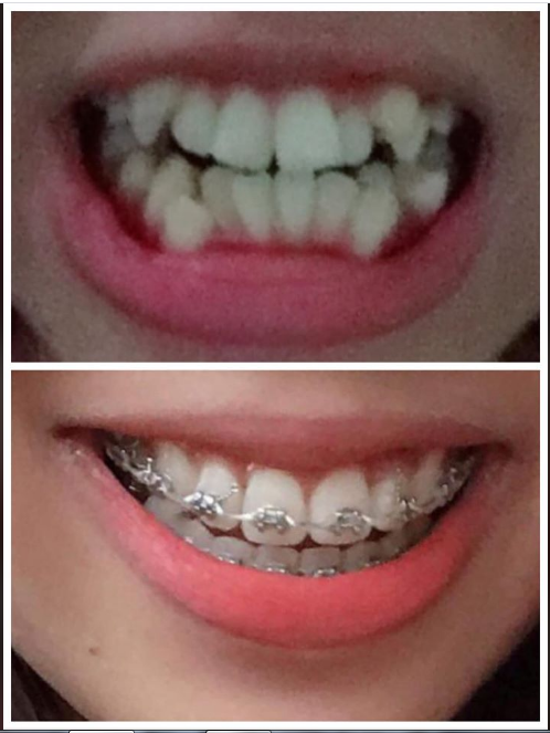 Thành quả niềng răng 1 năm 3 tháng của chị Kiều Anh, giờ đây nụ cười xinh đã dẫn trở lại trên gương mặt của chị