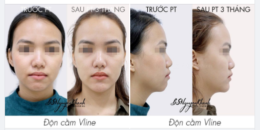 3. Độn cằm rồi có tiêm filler được không?