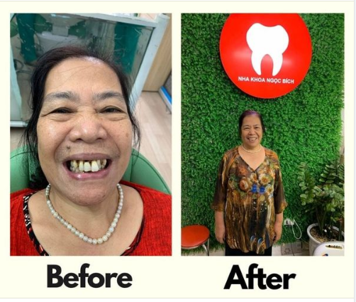 Trước và sau khi làm 10 răng cửa bn nhìn trẻ ra trông thấy.