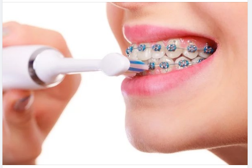 Vì sao phải vệ sinh răng miệng khi niềng răng?
