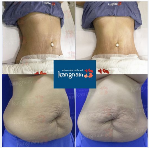 “Vỏ quýt dày có móng tay nhọn, mỡ bụng dày thì có các bác sĩ tại Kangnam”